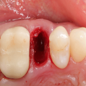 gIDEdental Extraction Socket – Preservation/Grafting; Immediate vs Delayed Implants; Pontic Site Development 2020